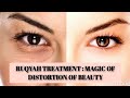 Ruqyah Treatment Distortion Of Beauty Due To Black Magic Evil Eye Envy