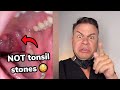 These May Look Like Tonsil Stones But They Are WAY Worse!