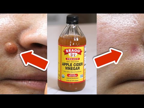 Apple cider vinegar removes warts in just 24 hours💥(Incredibly easy)🤯