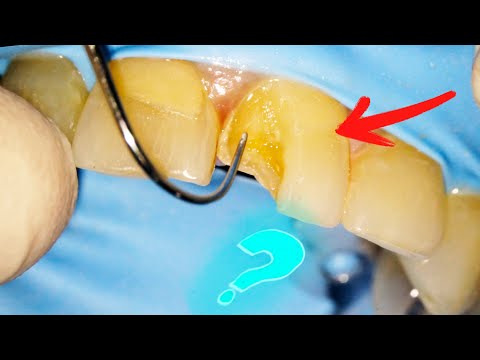 What Happens When You Chip a Tooth?