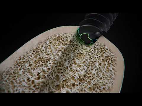 Straumann® BLX Implant System - Round Apex with Deep Threads Dynamic Bone Management