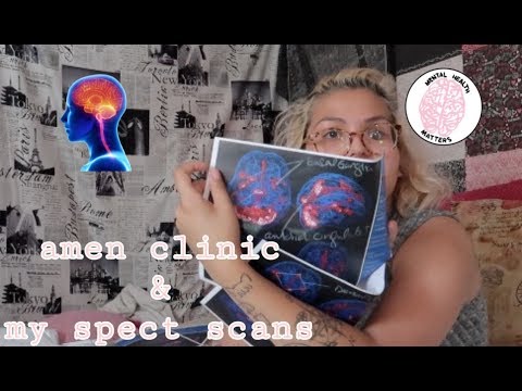 my amen clinic experience + brain spect scans