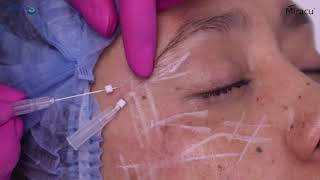 Hilos Miracu PDO Monofilamento I Dra. Vania Torres