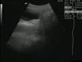 Coitus By Ultrasonography