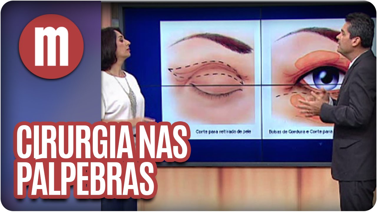 Mulheres - Saúde: Cirurgia nas pálpebras (29/03/16)