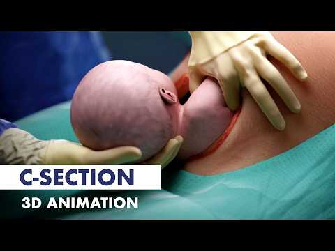 帝王切開で何が起こるか | 3Dアニメーション (What to expect during a C-section | 3D Animation)