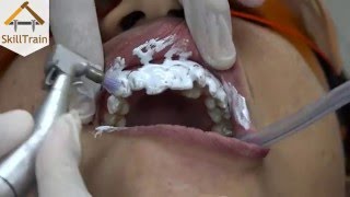 Cleaning & Bleaching (Hindi) (हिन्दी)