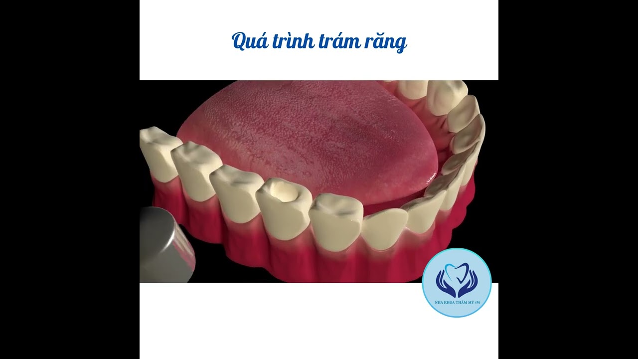 Quy trình trám răng  - Nha khoa uy tín quận 3