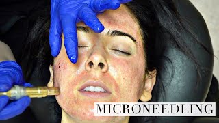 We Provide Skin Care Services Including Microneedling Facial Rejuvenation, Scar and Stretch Mark Tre