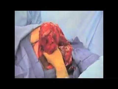 Den Grad der benignen Prostatahyperplasie Bestimmung Prostatakrebs Metastasen in der Leber als Live