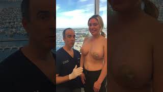 Download lagu Beautiful Breast Lift Result | Los Angeles | Dr. David Stoker mp3 Download lagu Beautiful Breast Lift Result | Los Angeles | Dr. David Stoker mp3