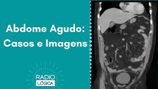 Abdome Agudo: Casos Clínicos e Imagens