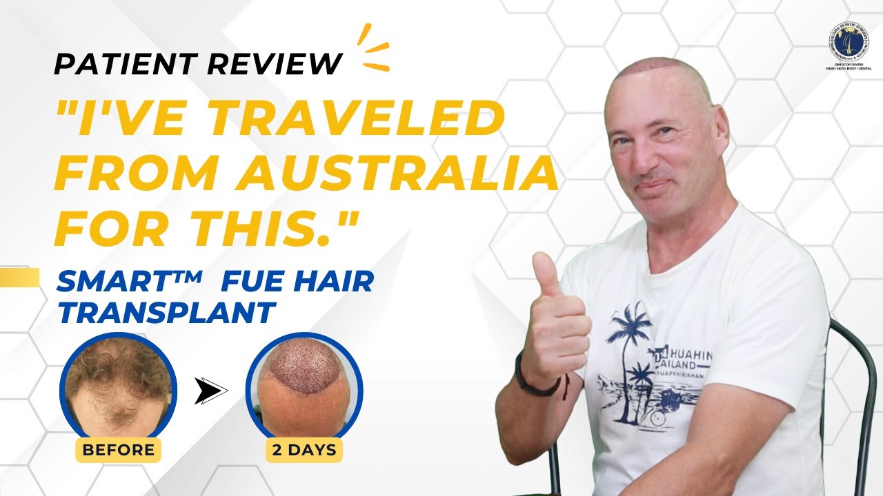 Amazing Results! 2nd SMART™ FUE by Andrew from Australia at GLOJAS Clinic
