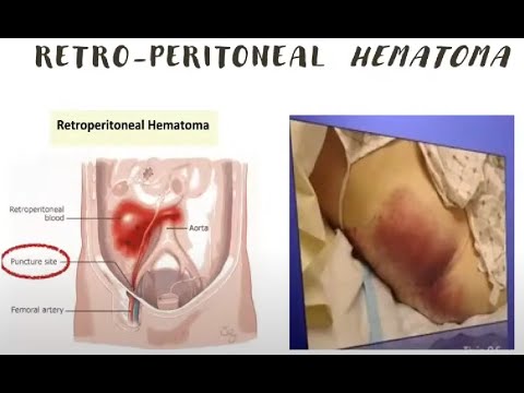 Neurovascular Clinics - femoral Access part 2 - Complications and its management