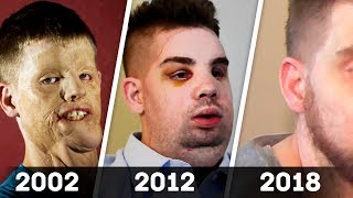 ВСЕ ИЗДЕВАЛИСЬ НАД НИМ, НО В 2012 ГОДУ ОН БЫЛ ПРООПЕРИРОВАН. 5 ЛЕТ СПУСТЯ ЕГО НИКТО НЕ УЗНАЛ!