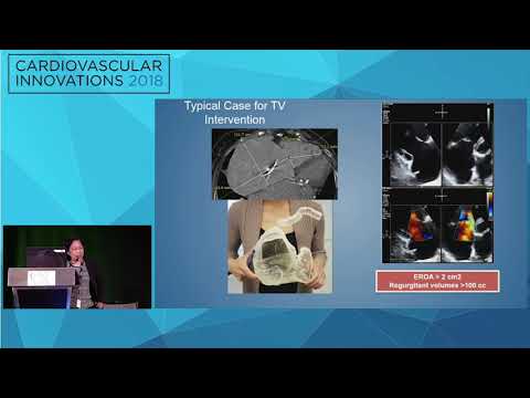 CVI2018 Session: What are the clinical endpoints for TR? - Rebecca Hahn, MD