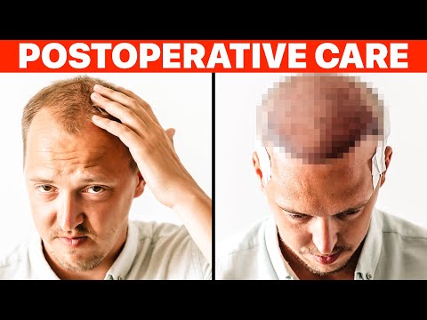 Hair Transplant: PostOp Recovery