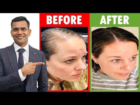 3 Home Remedies To Prevent Hair loss And Regrow Your Hair