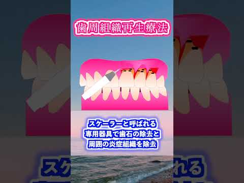 生命歯学科 歯周外科手術　歯周組織再生療法について解説します！　#shorts  #歯周外科　＃歯周病　＃歯を抜かない　＃歯を残す  #dentist #再生療法