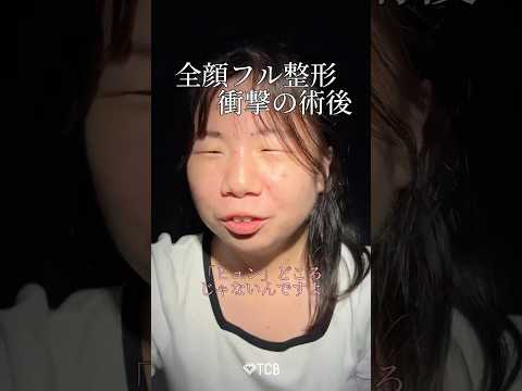 【二重整形】全顔フル整形 衝撃の術後 #shorts