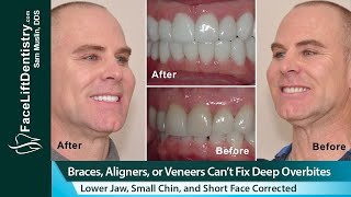 Braces, Aligners, or Veneers Can’t Fix a Deep Overbites, Short Face, and Weak Chin