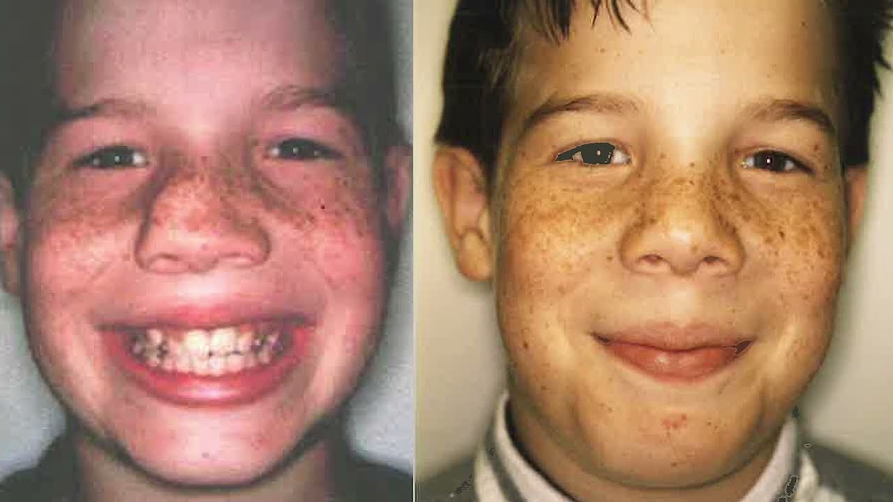 rhinoplasty before and after