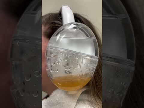 Are you tired of earwax buildup? Try a smarter solution: OtoSet