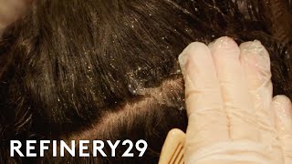 I Got A Scalp Facial To Treat Dandruff | Macro Beauty | Refinery29