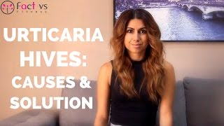 Urticaria Hives: Causes and Solution