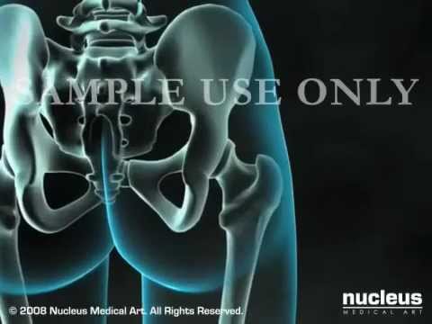 Mal di schiena schiena sopra la vita a destra Osteofitosi dugootroschatyh articolazioni artritiche