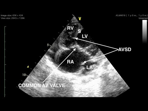 Complete Atrioventricular Septal Defect