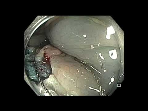 Kolonoskopia: mukozektomia endoskopowa (EMR) gruczolaka cewkowego okrężnicy poprzecznej