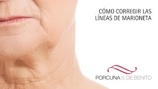 ¿Qué son y cómo se corrigen las líneas de marioneta