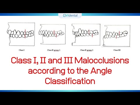 Class I, II and III Malocclusions according to the Angle Classification