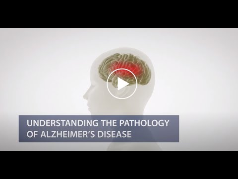 Understanding the Pathology of Alzheimer’s Disease