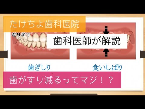 , title : '歯ぎしり・食いしばり(無自覚で歯を壊してる！気がついてないのはあなただけ！？)'