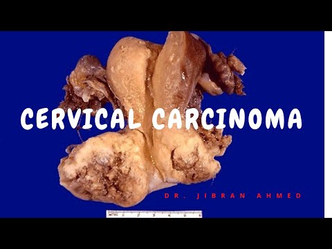 ENDOMETRIAL CARCINOMA II FEMALE GENITAL TRACT II ROBBINS 10TH E II PATHOLOGY LECTURE