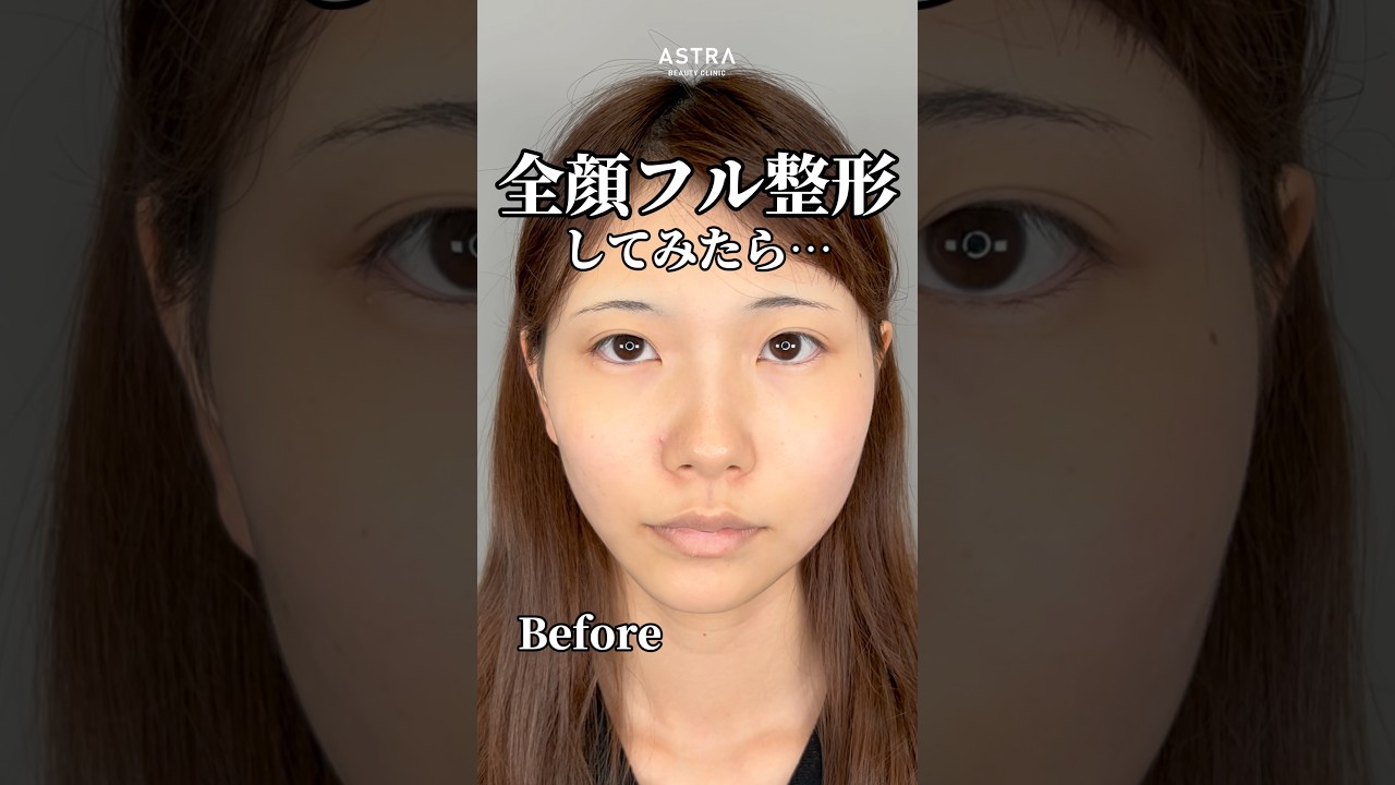 【全顔整形したら…整った✨🌿#忘れ鼻#鼻整形#塩満恵子#astrabeautyclinic】