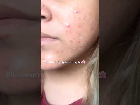 Day 1 of using Benzoyl Peroxide on acne #pcos #acne #acnejourney #makeup