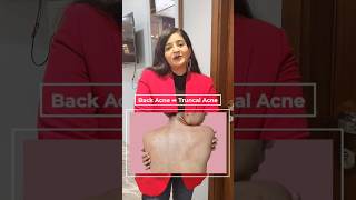 What is Back Acne or Truncal Acne | How To Treat Back Acne | #acnetreatment #dermatologist #skincare