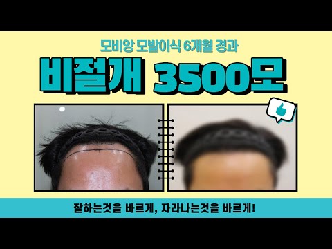 비절개 3500모 모발이식 6개월 경과영상!