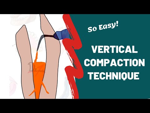 Obturation Techniques in Endodontics