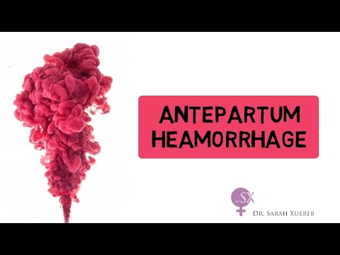 Antepartum Haemorrhage