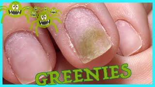 HELP ME! 🤢 To Not Get The Greenies Again! Nail Pro Teaches Student