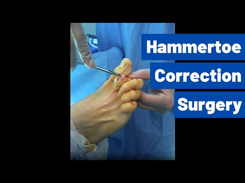 Hammer Toe Surgery