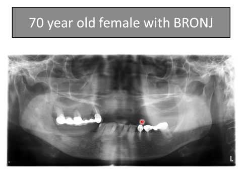 Osteoporotic Changes in the Jawbone