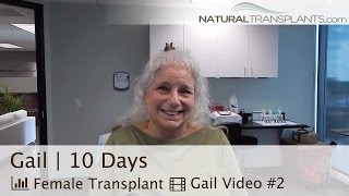 Female Hair Transplant Before and After - Jupiter, FL | Hair Restoration for Women and Men (Gail)