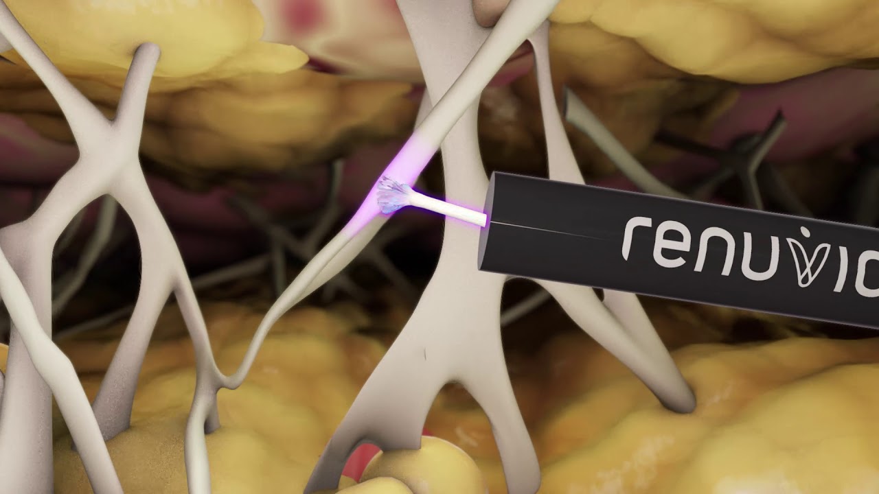 Renuvion Cosmetic Technology Animation