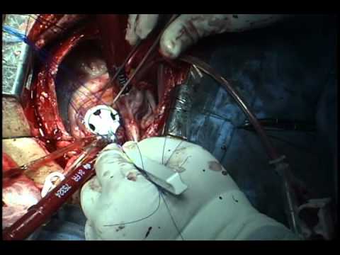 operacion a corazon abierto | pausalo52