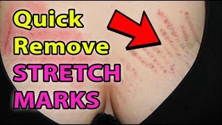 how to get rid of stretch marks butt - do stretch marks go away - stretch marks on breasts